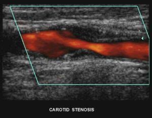 what is cas ultrasound|Imaging modalities to diagnose carotid artery stenosis: progress and.